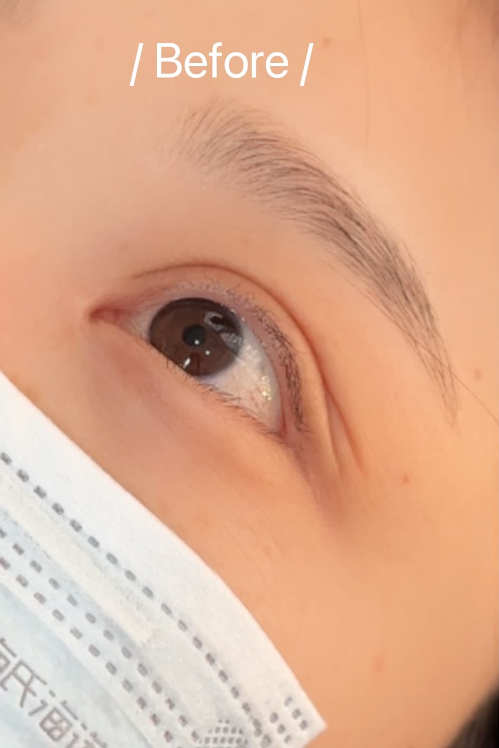 아이라인 시술 전