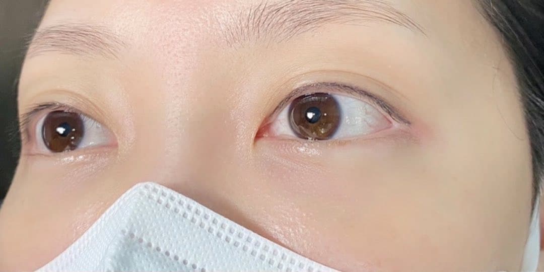 아이라인 시술 전