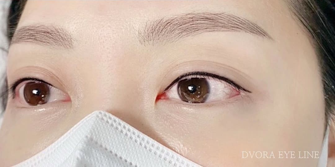 아이라인 시술 후
