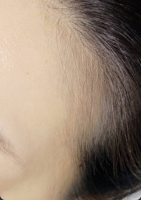 헤어라인 시술 전