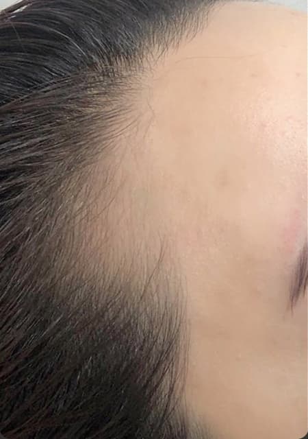 헤어라인 시술 전